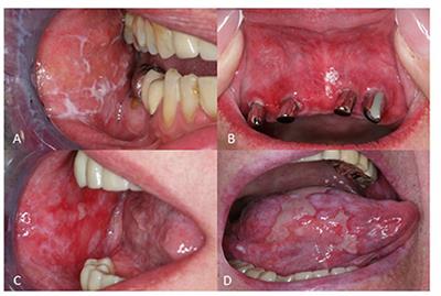 Therapeutic strategies for oral lichen planus: State of the art and new insights